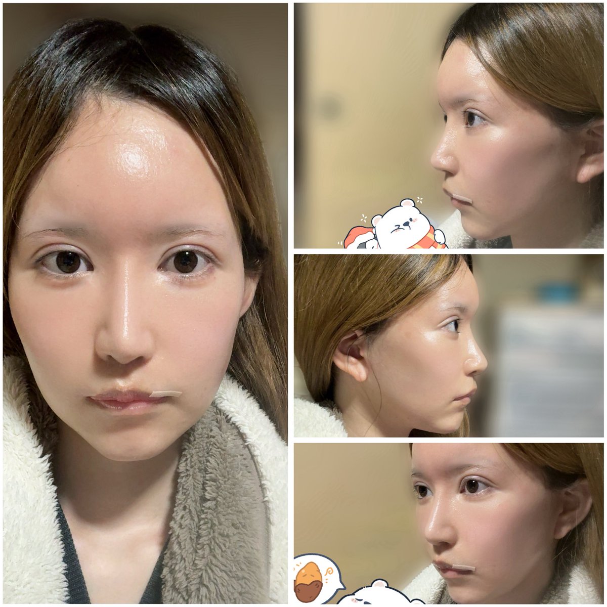 うる@切開リフトDT tweet media