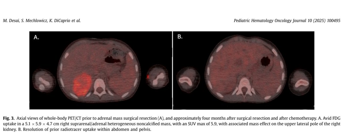 Pediatric Hematology Oncology Journal tweet media
