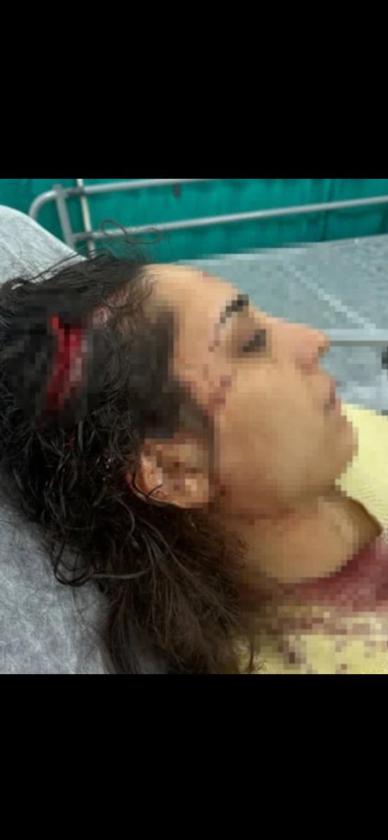 Bu #başıboş #köpek saldırısı bu gün Adana’da oldu! Bir önlem alacak yetkili yok mu? Vatandaşı köpekler yiyor! 
#sokaktabaşıboşolmaz