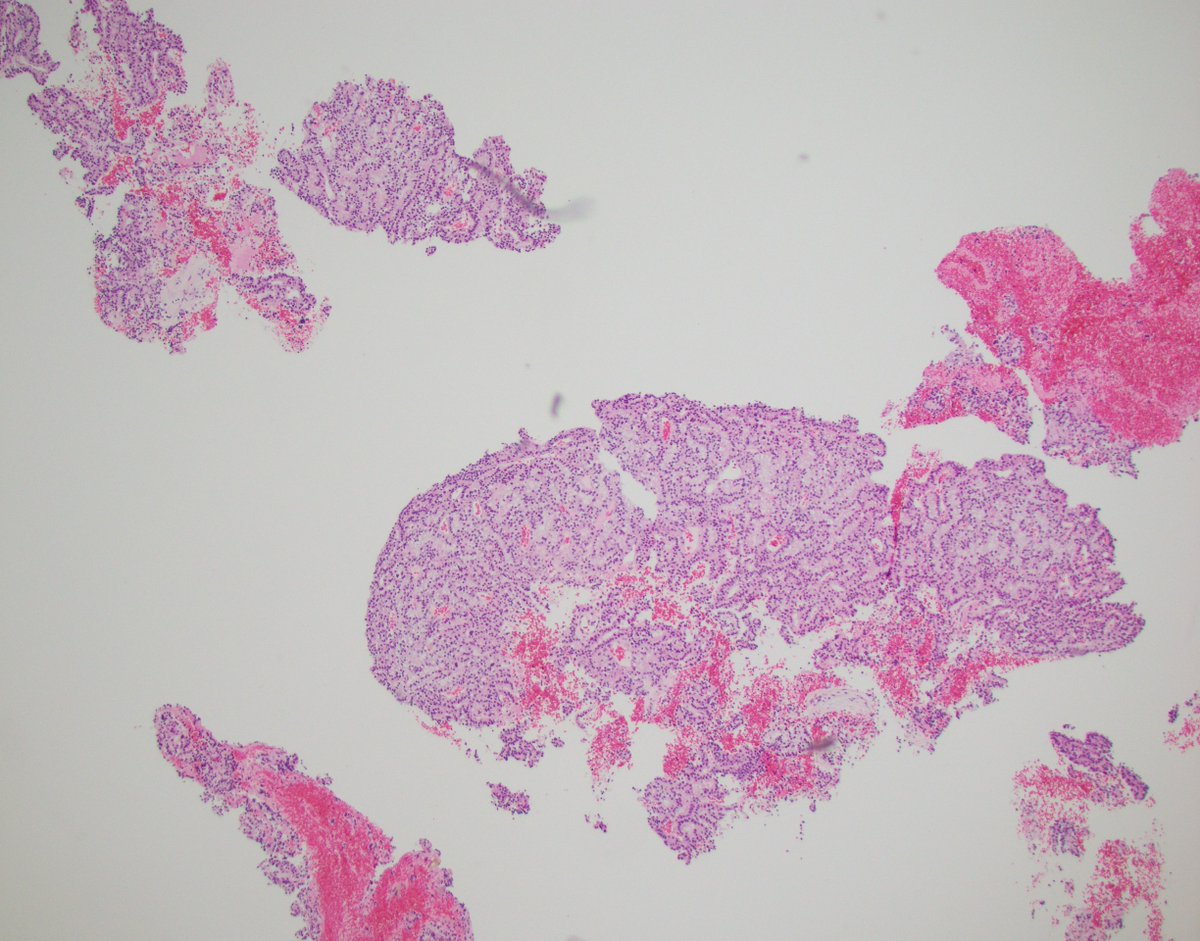 LaraHarikMD's tweet image. Can you make the diagnosis of TFE3 rearranged rcc on needle biopsy?

Yes!: 1) if you think about it and 2) are lucky to have enough tissue! (confirmed NONO:TFE3)

TFE3 IHC is not perfect but can be helpful as part of a screening panel

#GUPATH #pathology #pathres #kidneycancer