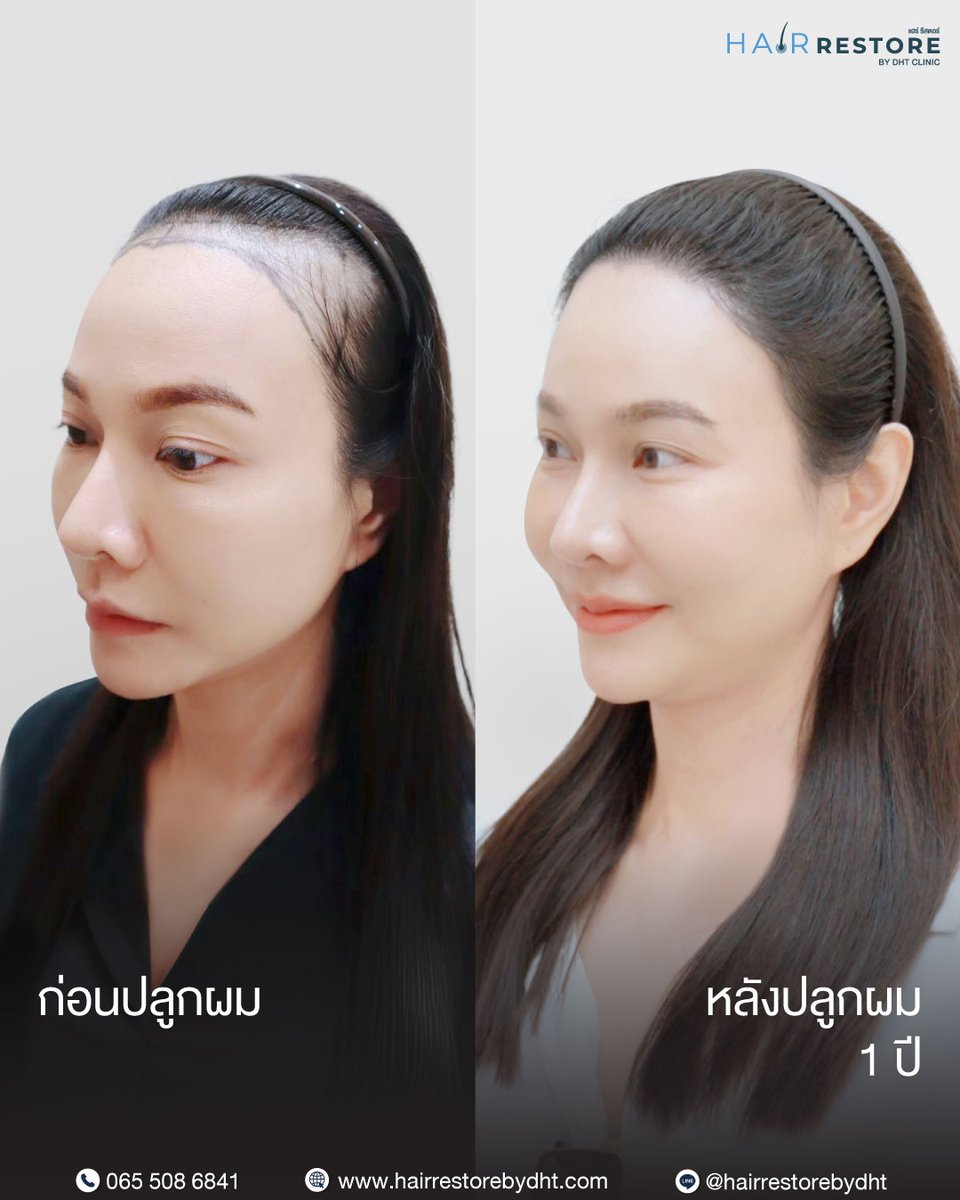 dhtluxclinic's tweet photo. From a forehead she once felt insecure about,
today her hairline looks softer and beautifully natural ✨Her forehead appears narrower, her facial frame more defined—
and her confidence has noticeably grown 💕A hair transplant isn’t just about changing your hairline. https://t.co/8O7brVXk0n