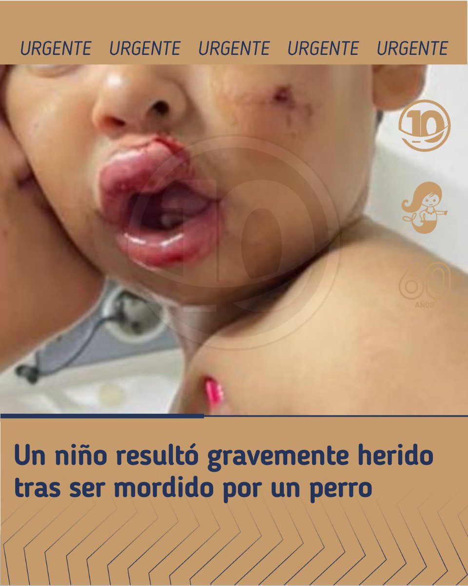 IMÁGENES SENSIBLES 
🚨 ATAQUE DE PERRO EN CERRITO SUR: UN MENOR RESULTÓ GRAVEMENTE HERIDO

Una familia caminaba con su hijo por calles del barrio Cerrito Sur cuando un perro considerado peligroso apareció y atacó al menor.

El niño sufrió graves lesiones en el rostro y la boca,