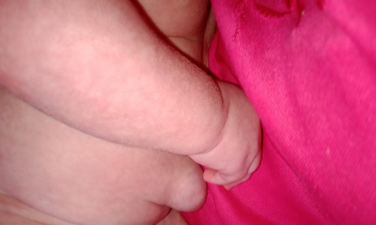 My baby's constant crying wasn't for no reason. I thought it was due to her heart condition... but we discovered her body was strangely swollen. Sometimes children suffer in silence. Please pray for her speedy recovery. 😫🥹💔

3 replies — even dots — can break the
 algorithm 😭