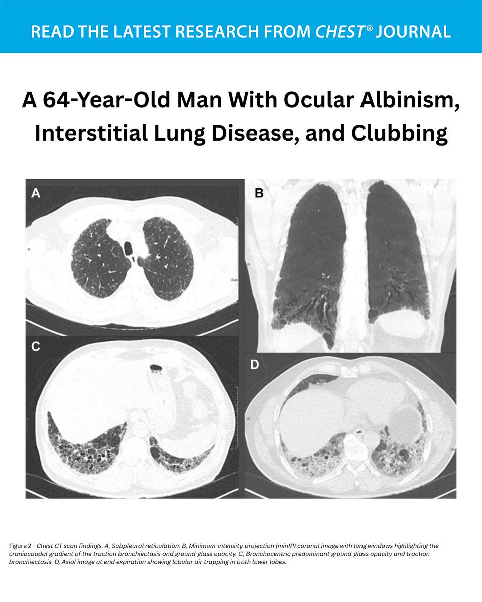 accpchest's tweet image. A 64-Year-Old Man With Ocular Albinism, Interstitial Lung Disease, and Clubbing

What's the diagnosis? Read the full CHEST Pearl in the February issue of the journal CHEST®: hubs.la/Q042nz3q0
#MedEd #JournalCHEST #LungDisease