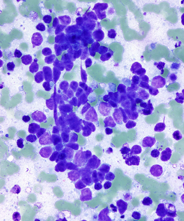 DrCycloPath's tweet photo. 💉🔬 #CytoQuiz 
🫁
A) Adenocarcinoma
B) Squamous Cell Carcinoma
C) Small Cell Carcinoma
D) Neuroendocrine Tumor
#CytoPath #Pathology https://t.co/YtBGey5nq7