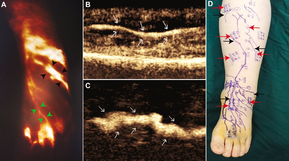 JVS - Venous and Lymphatic Disorders tweet media