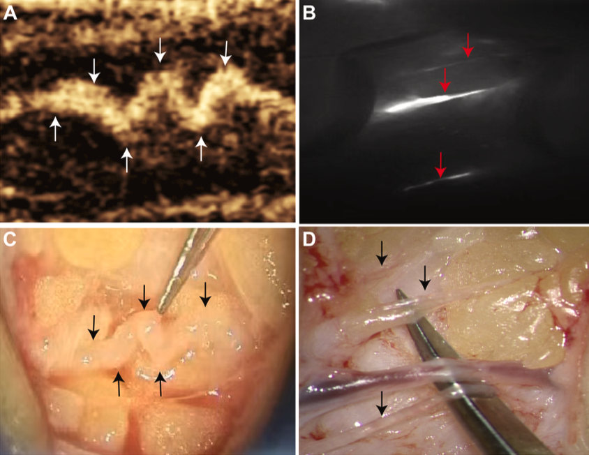 JVS - Venous and Lymphatic Disorders tweet media