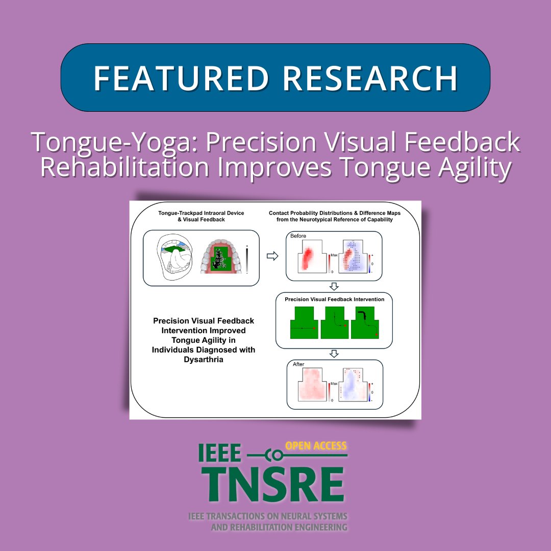 IEEEembs's tweet image. New research in IEEE TNSRE introduces the Tongue-Trackpad - an intraoral wearable providing real-time visual feedback to assess &amp;amp; improve tongue movement.

🔗 bit.ly/4txQ96L

#IEEEEMBS #WearableTech #RehabEngineering #SpeechDisorders #DigitalHealth