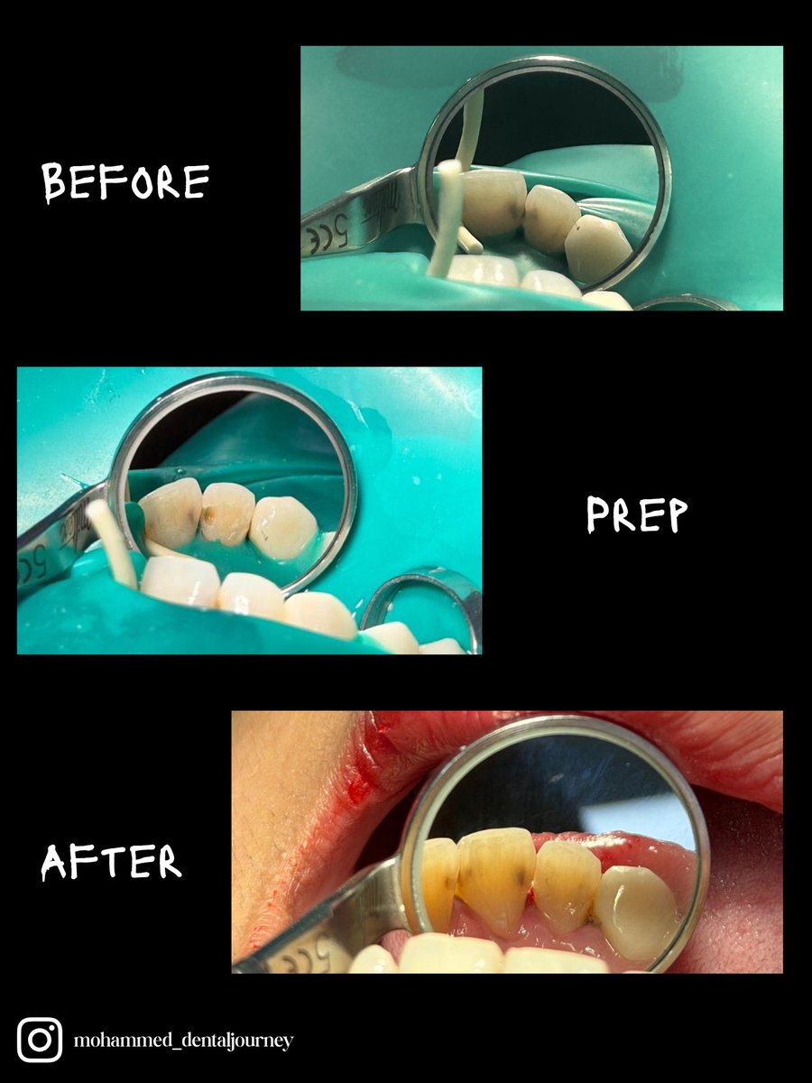 Class III Restoration 💪🏼🔥
Tooth #7

From caries &amp; discoloration ➡️ to natural anatomy &amp; seamless esthetics ✨
Precision. Detail. Perfection.