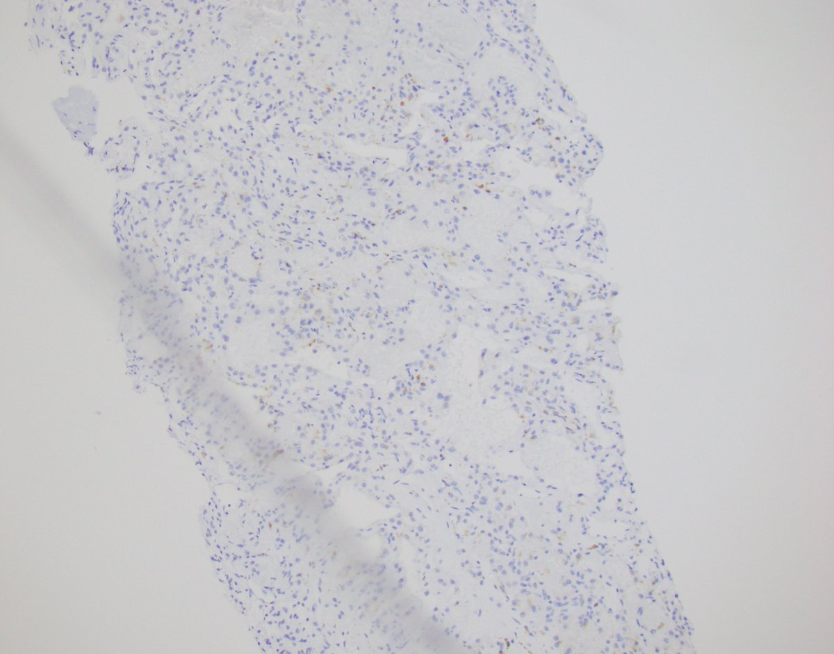LaraHarikMD's tweet photo. Clear cell RCC (CAIX + CK7 -) and pulmonary adenoca (TTF1 +)
Likely tumor to tumor #Metastasis
Trust your gut, dig into #history and stain when in doubt
#GUPath #pathology #pathres https://t.co/yUihOjTP35