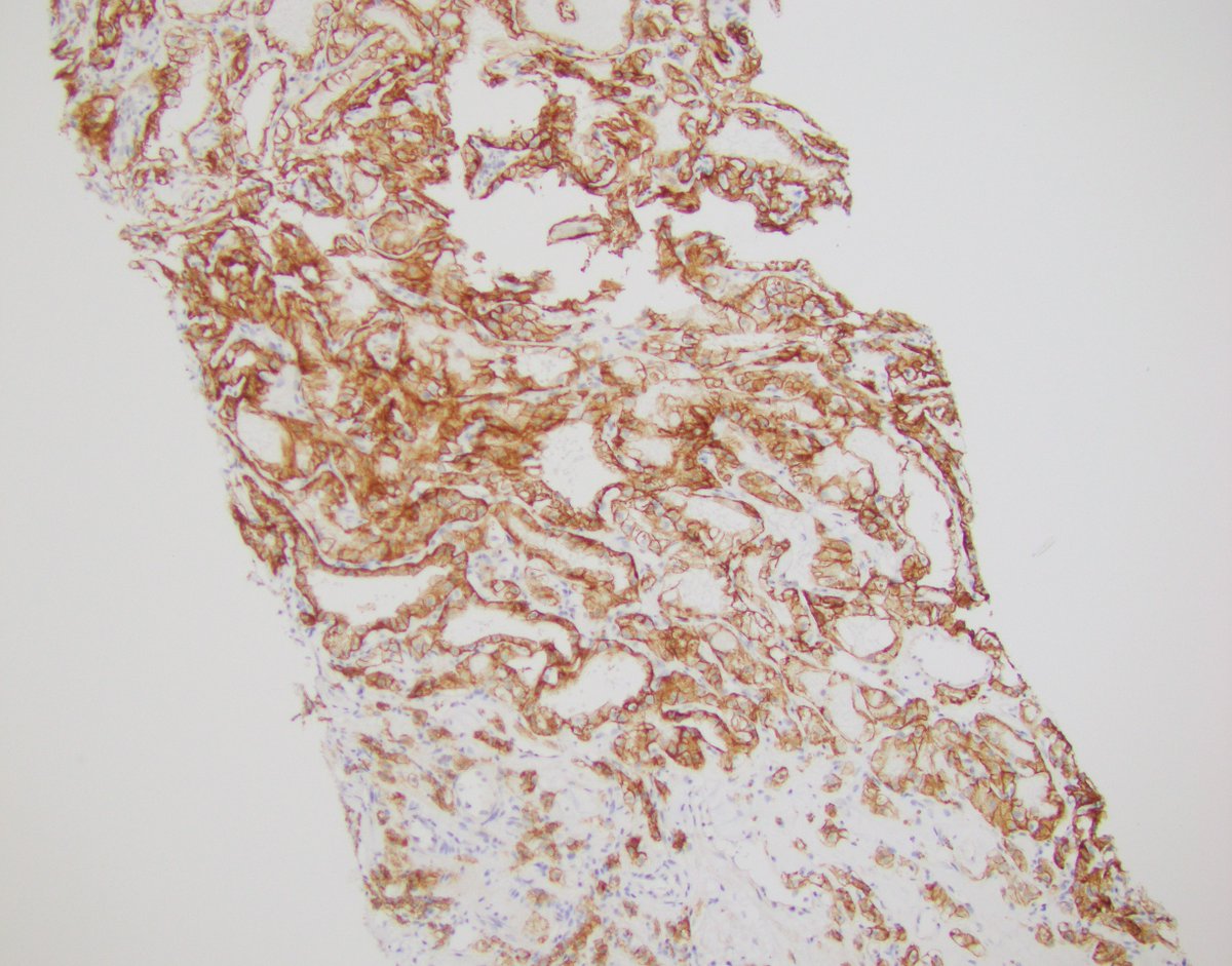 LaraHarikMD's tweet photo. Clear cell RCC (CAIX + CK7 -) and pulmonary adenoca (TTF1 +)
Likely tumor to tumor #Metastasis
Trust your gut, dig into #history and stain when in doubt
#GUPath #pathology #pathres https://t.co/yUihOjTP35