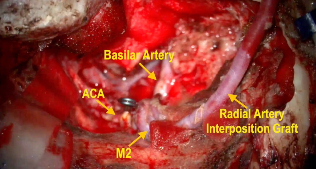 drufukerginoglu's tweet photo. New in Neurosurgical Focus Video: staged CCA–MCA bypass enabled safe resection of complex ICA-encasing skull base meningioma. Highlights the critical role of cerebral revascularization in modern skull base surgery.
https://t.co/7NBRQX0xsD
#Neurosurgery #SkullBase #Cerebrovascular https://t.co/qLOEEs5vue