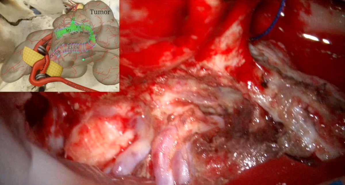 drufukerginoglu's tweet photo. New in Neurosurgical Focus Video: staged CCA–MCA bypass enabled safe resection of complex ICA-encasing skull base meningioma. Highlights the critical role of cerebral revascularization in modern skull base surgery.
https://t.co/7NBRQX0xsD
#Neurosurgery #SkullBase #Cerebrovascular https://t.co/qLOEEs5vue