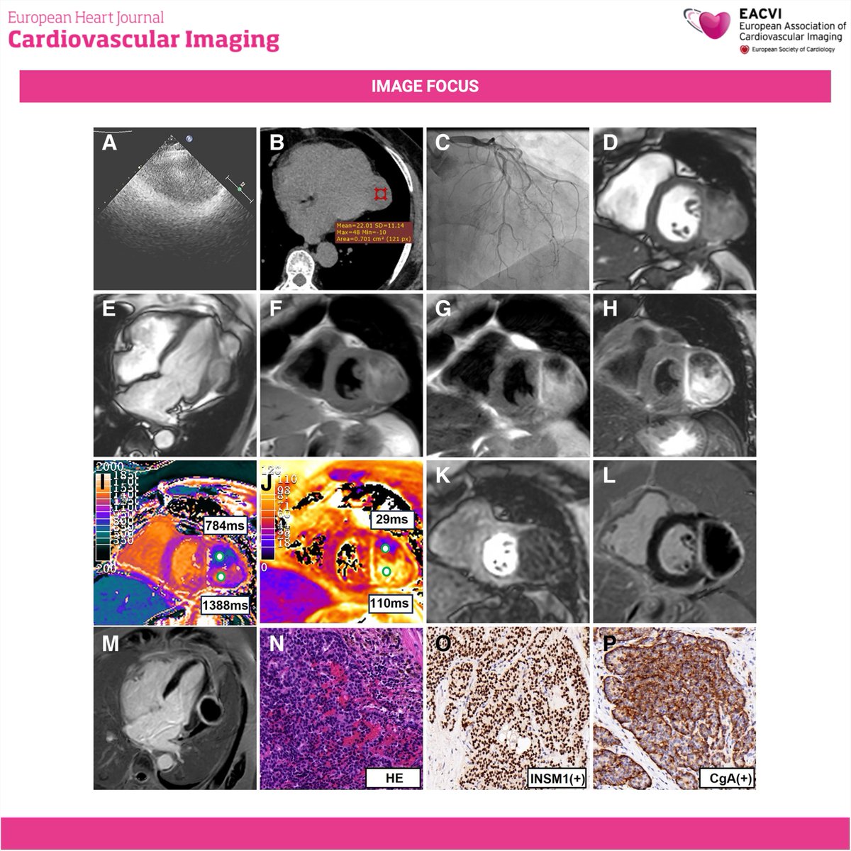 EHJCVIEiC's tweet image. #EHJCVI🫀A rare cardiac case to look out for 👀: A 66-year-old woman with exertional chest &amp;amp; back pain, T-wave inversions in V1–V6, aVL 📉, normal coronaries, and a LV lateral wall mass on #EchoFirst and #whyCCT 👉 #WhyCMR and histology reveal these findings 🧲🔬