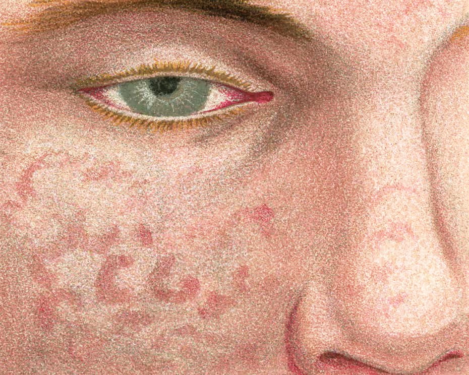 "The 53-year-old had called an ambulance when what she had assumed was flu became so severe she could barely walk, and she experienced diarrhoea and violent vomiting. It wasn’t flu. In fact, Ladd had caught measles."

"My body’s systems had started to shut down,” she says,