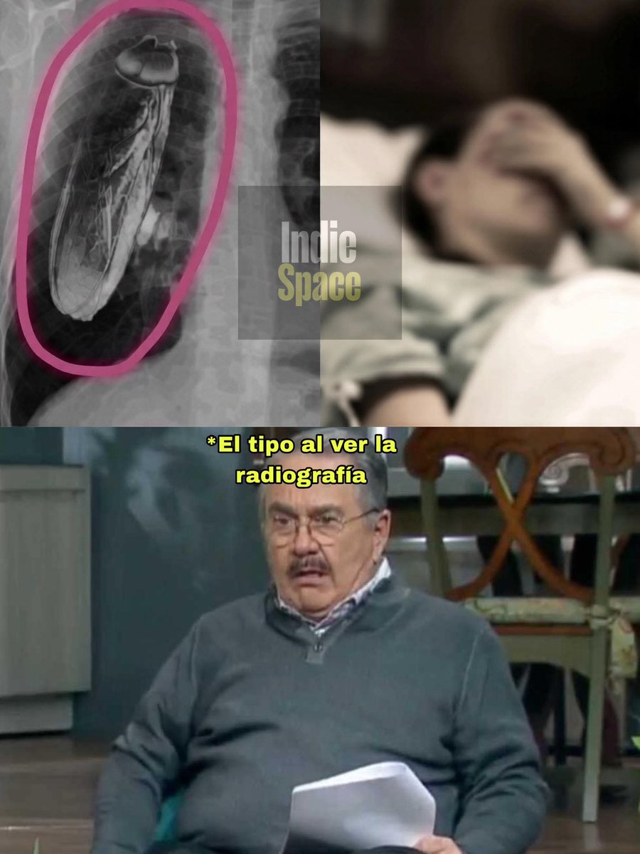 Animalesaprieto's tweet image. En Kenia, a un paciente le dijeron después de una radiografía que tenía una cucaracha viva en el pecho… y hasta lo mandaron a Singapur para atenderlo.

Cuando llegó allá y lo revisaron bien, descubrieron que el insecto no estaba dentro de su cuerpo, sino metido en la máquina de