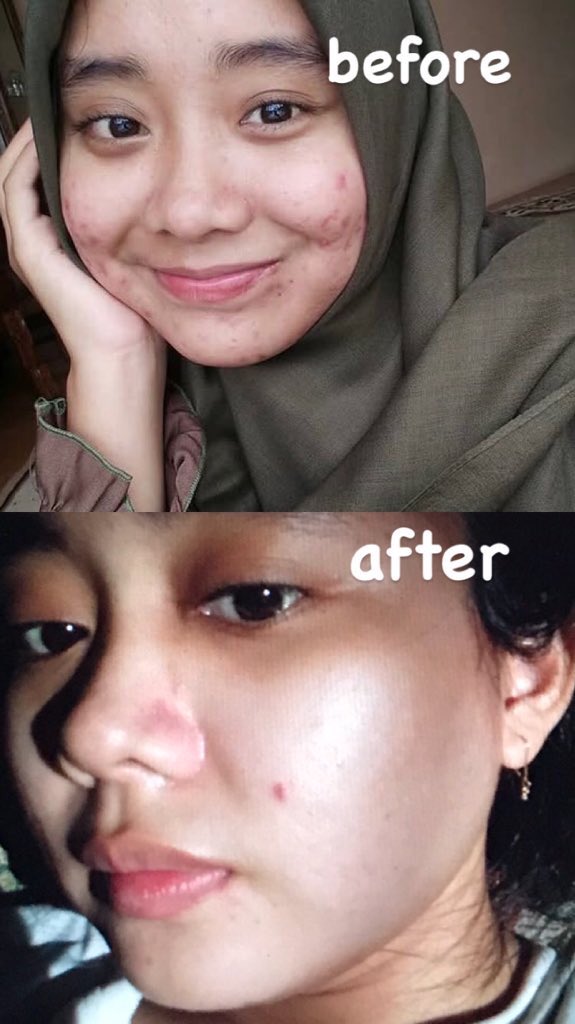 toxipc's tweet photo. buat acne fighter yang lagi insecure karna jerawat dan bekas jerawat merah/hitam bahkan bopeng, aku perkenalkan Some By Mi Snail Truecica Miracle Repair Serum 🤩 demi apa ini beneran ngebantu aku bangetttttt huhu 🥺 https://t.co/JNZnYp5jij