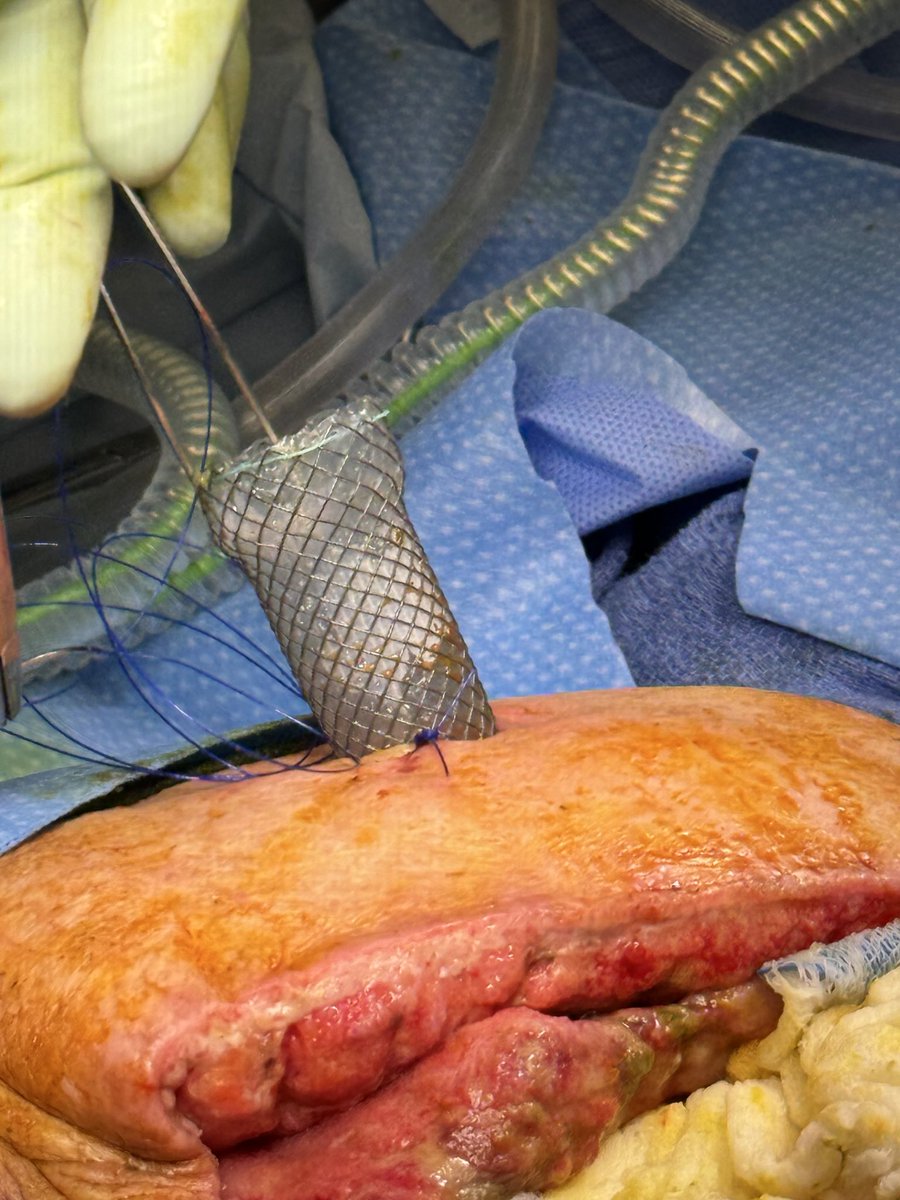 CollinMD's tweet photo. @DrSalihTokmak @rbarbosa91 Very cool! Esophageal stent? Looks similar to one I used to create an ostomy after a leak in a frozen abdomen: https://t.co/e2y2eNkdor