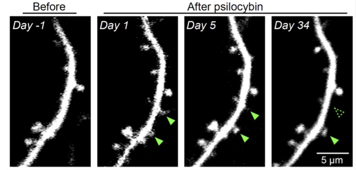 PaulAustin3w's tweet image. We can now watch psilocybin grow new brain connections in real time.

Not metaphorically. Not "neuroplasticity" as a vague buzzword. Actual, physical structures — dendritic spines — sprouting from cortical neurons within 24 hours of a single dose.

A team at Yale used chronic…