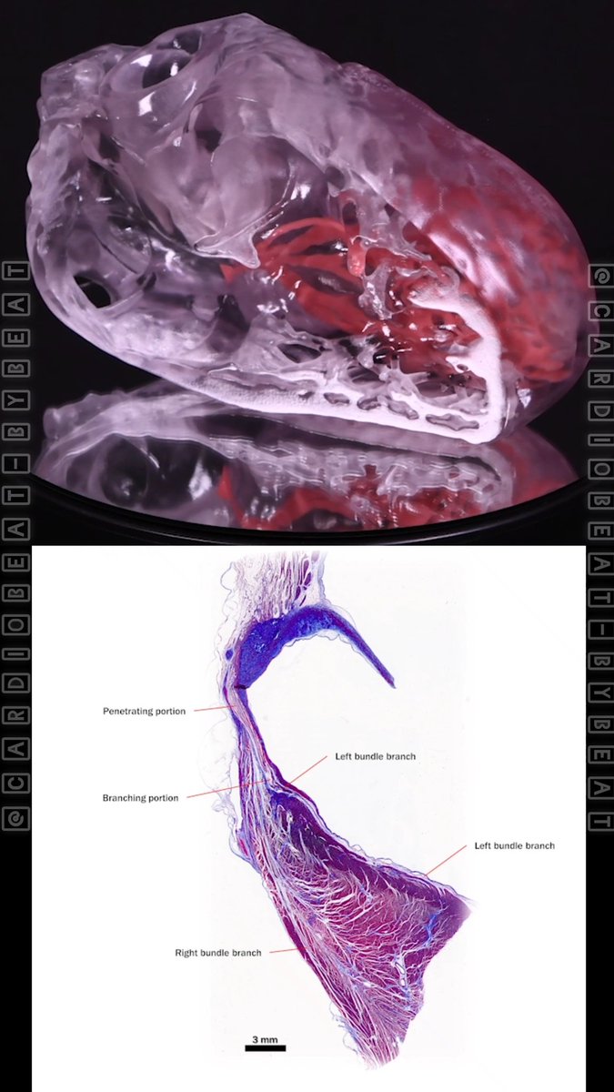 CardioBeat_'s tweet photo. https://t.co/lTtVKO8Kpo
Three-dimensional print of the atrioventricular bundle.
#CardioEd #Anatomy #Cardiology #HisBundle #MedicalInnovation https://t.co/NIa7gHpbj9