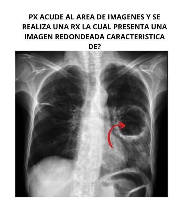 An acute patient arrives at the imaging department and a chest X-ray is performed, which shows a characteristic rounded image of which condition?
#MedTwitter #FOAMed <a href="/dr_manish_ydv/">अहिरावण</a> <a href="/Dr_Shiv_kumar_/">Dr. Shiv_Kumar</a> <a href="/DrAkhilX/">Dr. Akhil 🇮🇳</a> <a href="/DrArslan480/">The Medics🩺💊💉🏥</a> <a href="/drobiy12/">Dr. El_Nino</a> <a href="/hemo_shk/">Dr.Haitham Hamoud | د.هيثم</a>