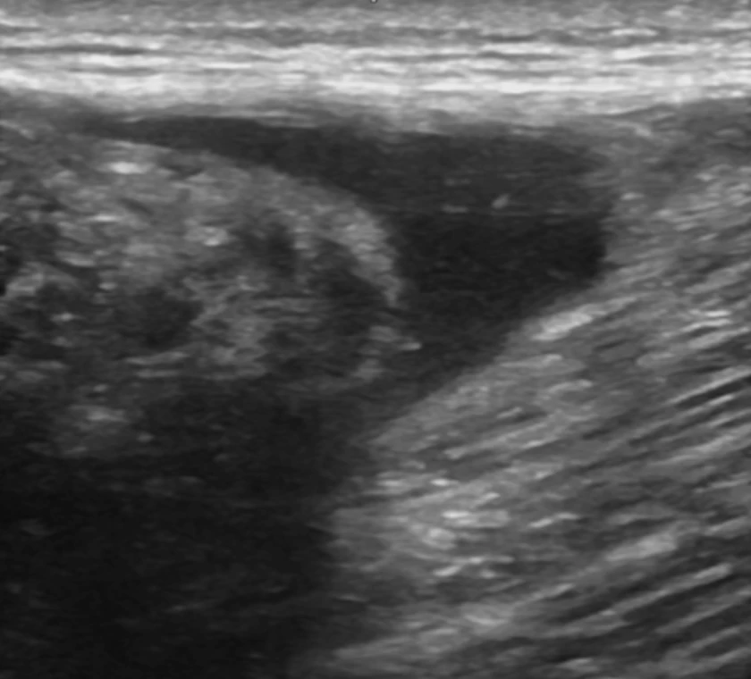 CMyersPhysio's tweet photo. ☕️ It's “T” Time!
T-junction injury: 32-year-old sprinter, 400 m run 10 days ago. Minimal pain, no swelling, slight power loss.
Key questions:
❓ Surgery referral?
❓ Is ultrasound enough?
❓ MRI needed — why?
#ItsTTime #Ultrasound #MSK https://t.co/8khAoNVH8d