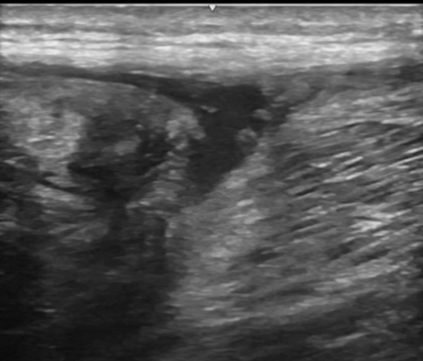 CMyersPhysio's tweet photo. ☕️ It's “T” Time!
T-junction injury: 32-year-old sprinter, 400 m run 10 days ago. Minimal pain, no swelling, slight power loss.
Key questions:
❓ Surgery referral?
❓ Is ultrasound enough?
❓ MRI needed — why?
#ItsTTime #Ultrasound #MSK https://t.co/8khAoNVH8d