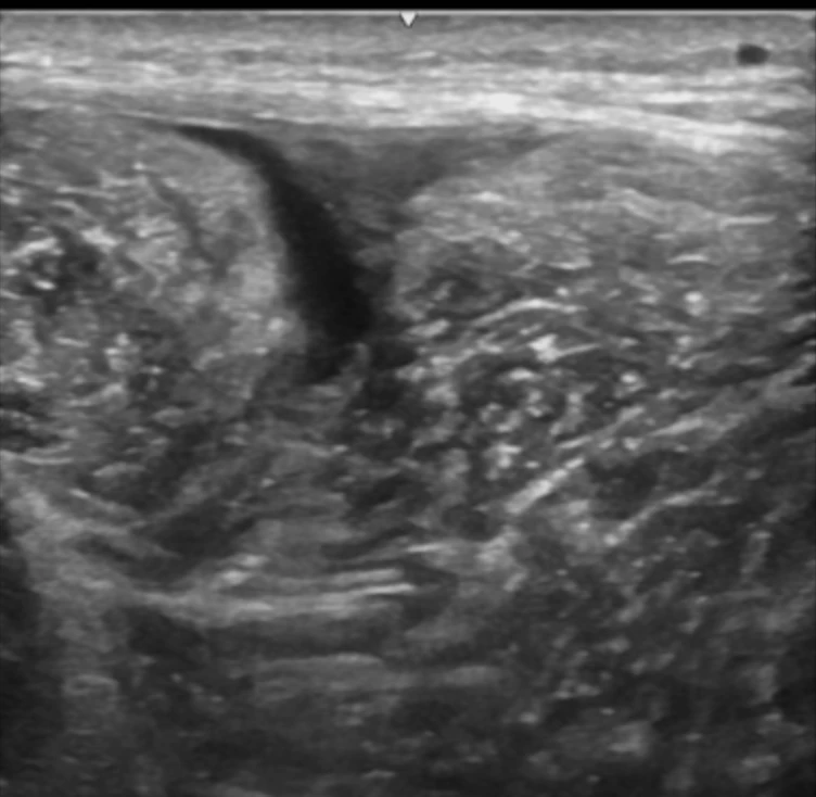 CMyersPhysio's tweet photo. ☕️ It's “T” Time!
T-junction injury: 32-year-old sprinter, 400 m run 10 days ago. Minimal pain, no swelling, slight power loss.
Key questions:
❓ Surgery referral?
❓ Is ultrasound enough?
❓ MRI needed — why?
#ItsTTime #Ultrasound #MSK https://t.co/8khAoNVH8d