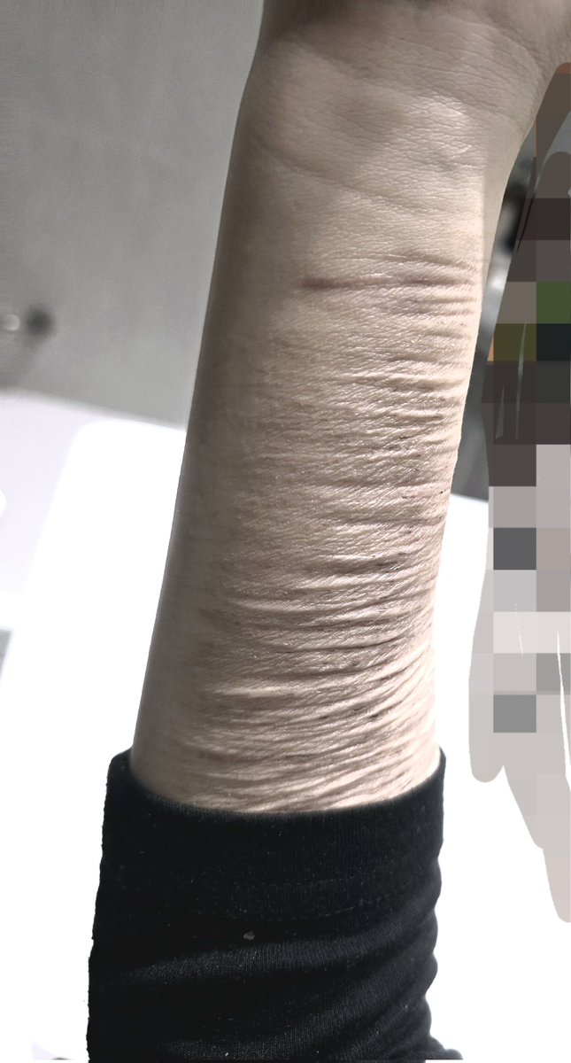 #자해 안한지 2주