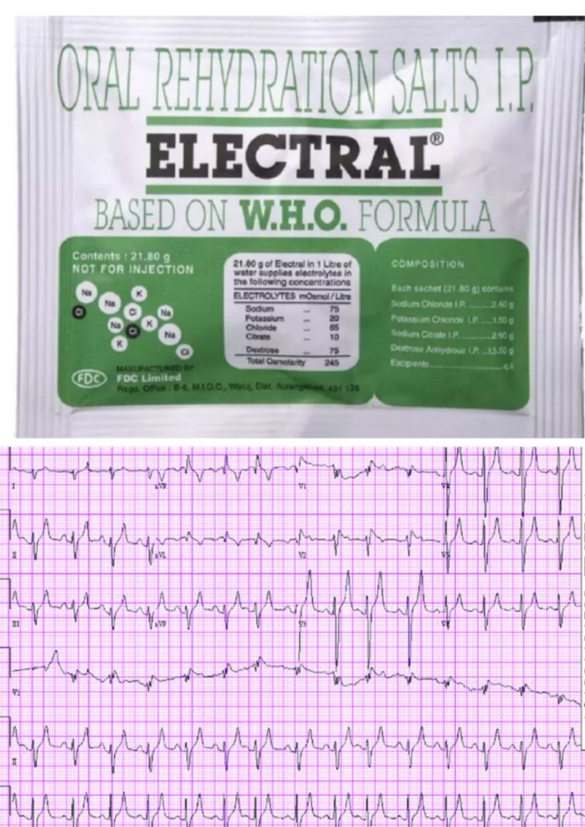 A "harmless" packet of WHO ORS almost killed my patient yesterday.

Yesterday’s ER night shift was a reminder of why quackery is a public health crisis.

A known CKD patient with a history of recurrent hyperkalemia (last K+ 5.3) had mild diarrhea. A quack’s advice? "Just drink