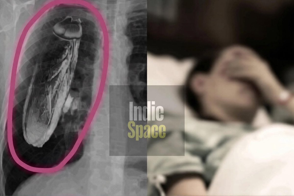 In Kenya, a patient was told after an X-ray that he had a live cockroach inside his chest, and they recommended him to go to Singapore for treatment. 

When he arrived there and they examined him properly, they discovered that the insect wasn’t inside his body at all — it was