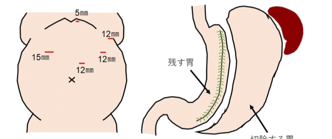 デブが痩せるために胃を切る手術、色々合わせて100万円ぐらいかかるんだけど、保険適用なのあなたは賛成できますか⁉️　あなたは一生懸命働いたお金をどっかのデブのために払えますか⁉️
