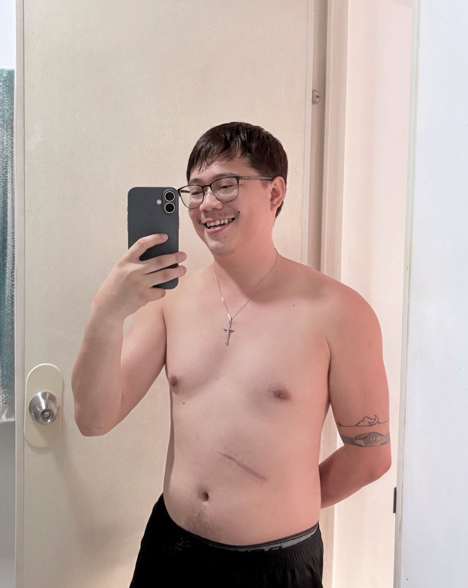 iMikefg_91's tweet photo. 6 months since my open cholecystectomy 🙏✌️ https://t.co/lM2XfCh2cq