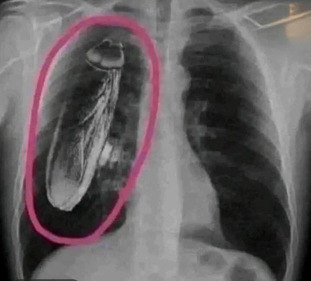 Kenya 🇰🇪

In Kenya, a patient was told after an X-ray at a government hospital that he had a live cockroach inside his chest, and they recommended him to go to Singapore for treatment. 

When he arrived there and they examined him properly, they discovered that the insect wasn’t