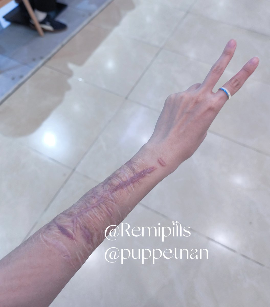 puppetnan's tweet photo. 我就这样带着一手疤在小县城乱走 https://t.co/epROB1WYi4
