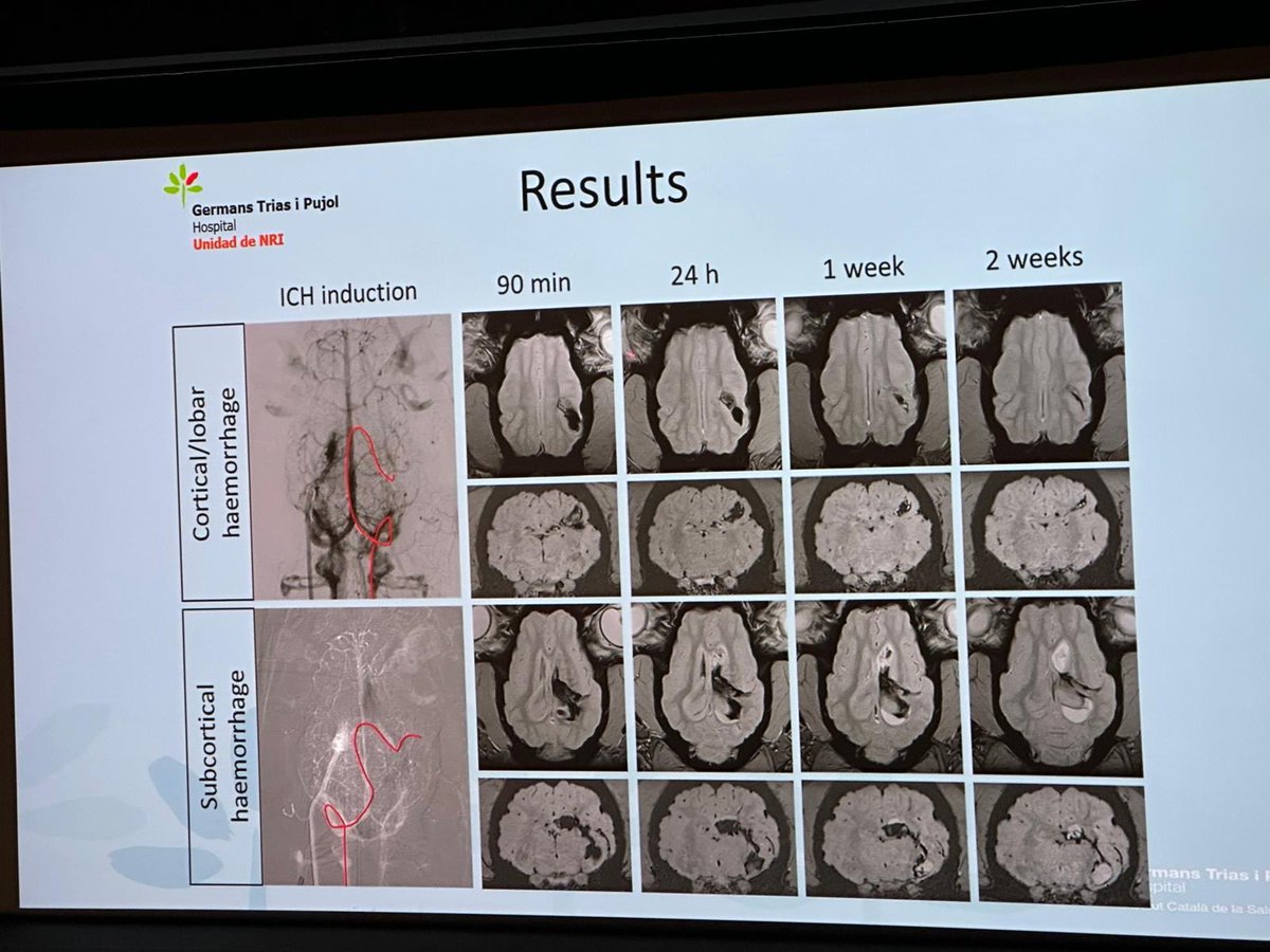 CarlosC74716941's tweet photo. I'm very proud to have presented the paper
"Novel Intracerebral Hemorrhage Stroke Model Using Endovascular Approach in Swine"
#ABCWIN2026 @valdisere
Great team: @TGasull @OSistac @Agarciaserran @soree95
@IGTP @GTRecerca @hgermanstrias
#stroke #animalmodels https://t.co/wMWsh4O4yv