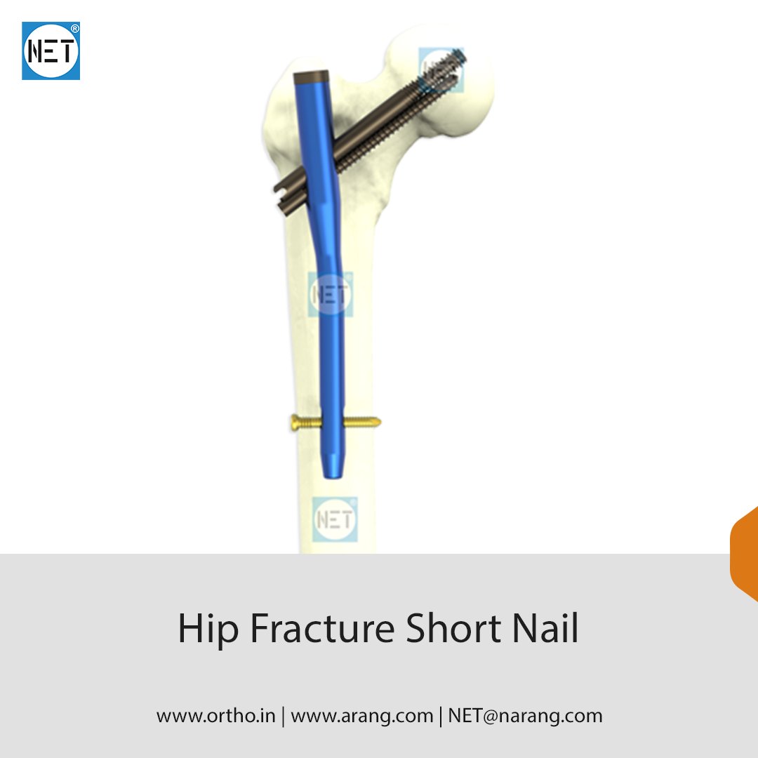 Hip Fracture Nails (HFN Type) are intramedullary fixation devices engineered for the treatment of proximal femoral fractures.
orthopaedic-implants.com/interlocking-n…