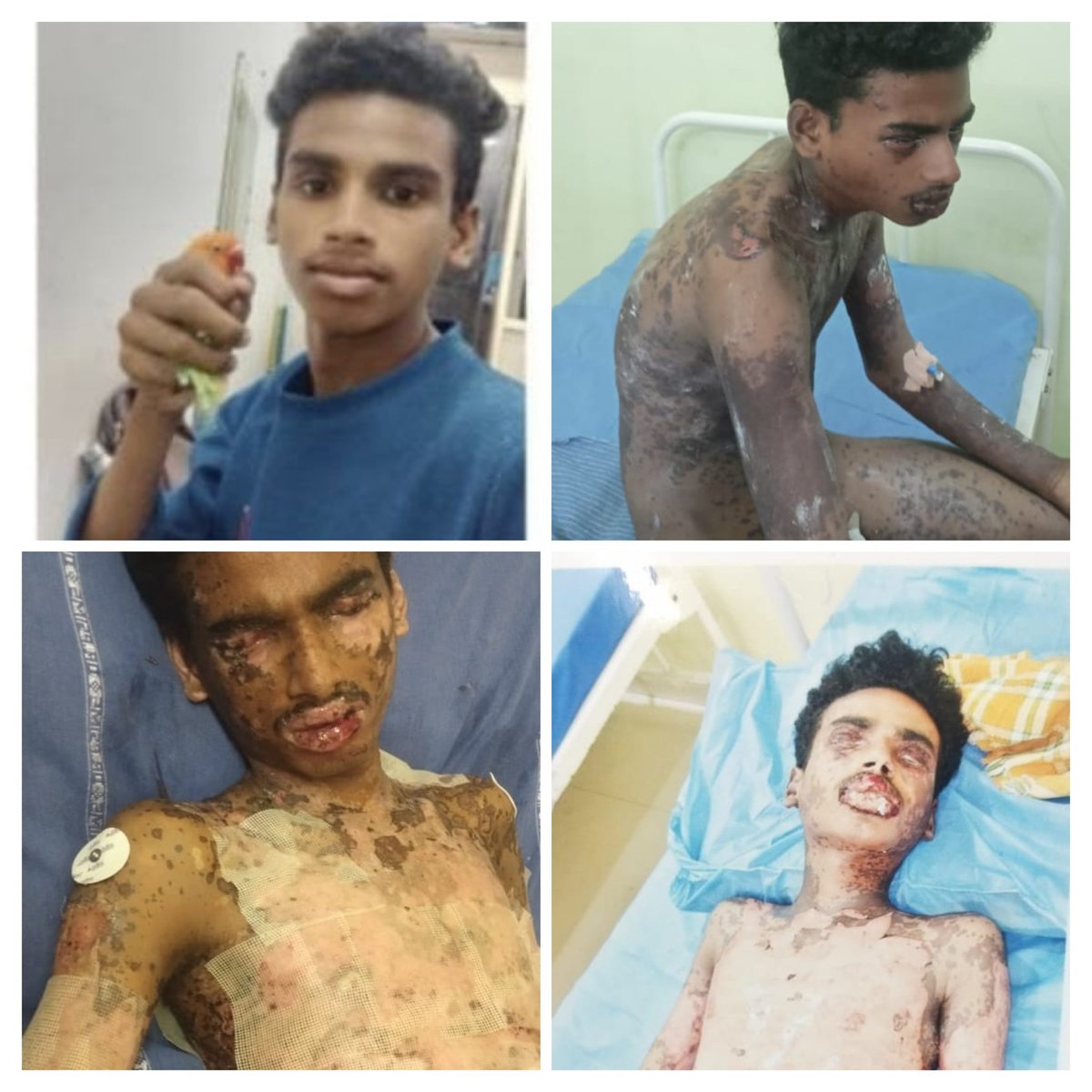 సహాయం కోరుతూ విన్నపం :Patient Name:- jaggaraju Badri
Father Name:- jaggaraju seetharamaraju
Phone pay Number:- 9390766327
Hospital:- Pinnamaneni Siddhartha General Hospital vijayawada 
Help me frds
Like and retweet better to reach 
<a href="/SKNonline/">SKN (Sreenivasa Kumar)</a> <a href="/TrendsPrabhas/">Prabhas Trends</a> <a href="/PawanKalyan/">Pawan Kalyan</a>  <a href="/ivdsai/">Prabhas Fan</a>