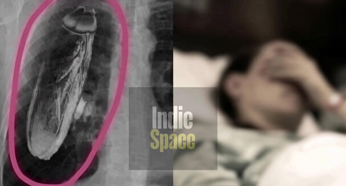 Bro imagine this nightmare 😱

You go for a routine chest X-ray in Mumbai. Doctor stares at the screen, face pale:

"Sir… there's a LIVE COCKROACH in your chest. It's moving. We can't handle this here — you need advanced surgery in JAPAN. Pack your bags NOW!"

Heart racing.