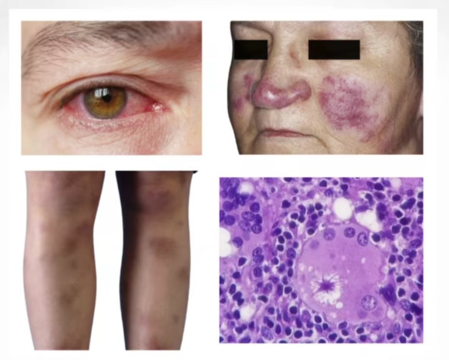 What is the most likely diagnosis?

A. Tuberculosis
B. Sarcoidosis
C. Histoplasmosis
D. Wegener's granulomatosis