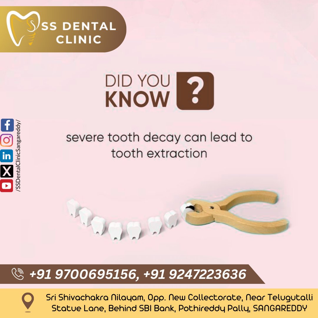 SSDentalClinics's tweet photo. #ToothDecay #DentalAwareness #SaveYourTooth #Sangareddy #SSDentalClinic #OralHealth #ToothExtraction #DentalCare #SangareddyDentist #HealthySmile #DrShivaRamaKrishna #DrShivaratna #PothireddyPally #ToothacheRelief #DentalCheckup #PreventiveDentistry #SmileProtection https://t.co/kr3GF4zYyn