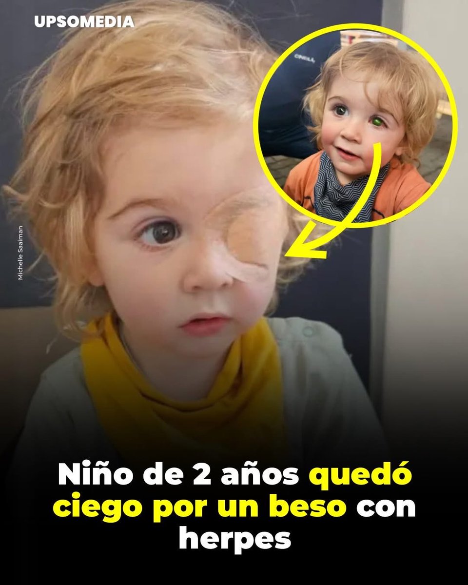 RenacidoParody's tweet image. Un simple beso de "cariño" condenó a este pequeño a la oscuridad. 

 La pesadilla de la familia Saaiman comenzó cuando notaron una infección en el ojo de su hijo, Juwan. Lo que parecía algo leve, terminó siendo una tragedia irreversible.

Los médicos confirmaron lo impensable: