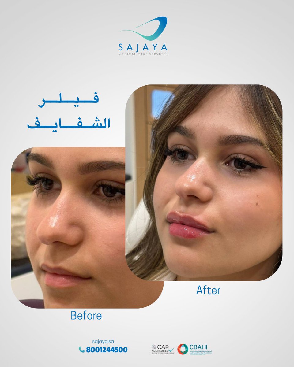 جمال الشفايف يبدأ من التوازن ✨
فيلر الشفايف بلمسة طبية دقيقة تبرز جمالك الطبيعي 

احجزي موعدك الآن 
📞8001244500
🌐Sajaya.sa

#السعودية #الرياض #يوم_التاسيس
