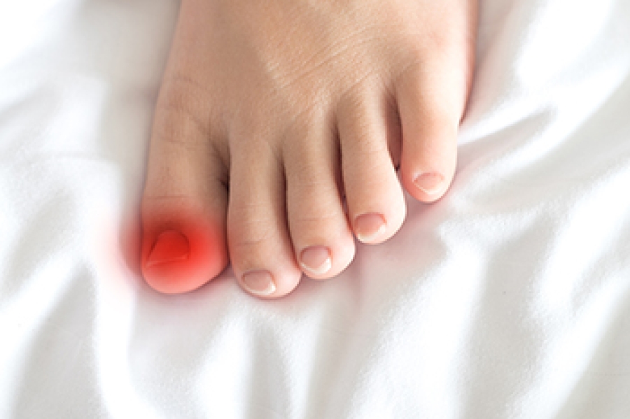 Managing Ingrown Toenails dlvr.it/TR0t8T
