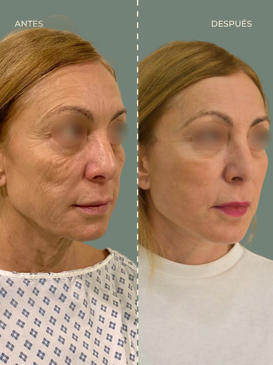 #AntesYDespués de Lifting Facial Deep Plane. 🌟

Con este método rejuvenecemos el rostro en un plano más profundo. Conseguimos una cicatrización mejor y resultados más naturales.

¡Gracias por confiar en nosotros!