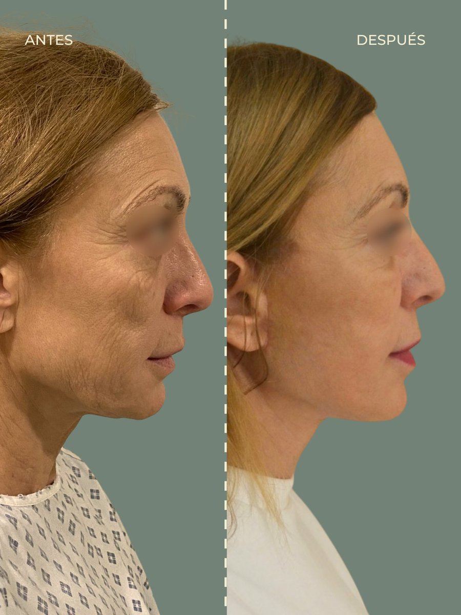 ClinicaFEMM's tweet photo. #AntesYDespués de Lifting Facial Deep Plane. 🌟

Con este método rejuvenecemos el rostro en un plano más profundo. Conseguimos una cicatrización mejor y resultados más naturales.

¡Gracias por confiar en nosotros! https://t.co/eX2pqbyQQl