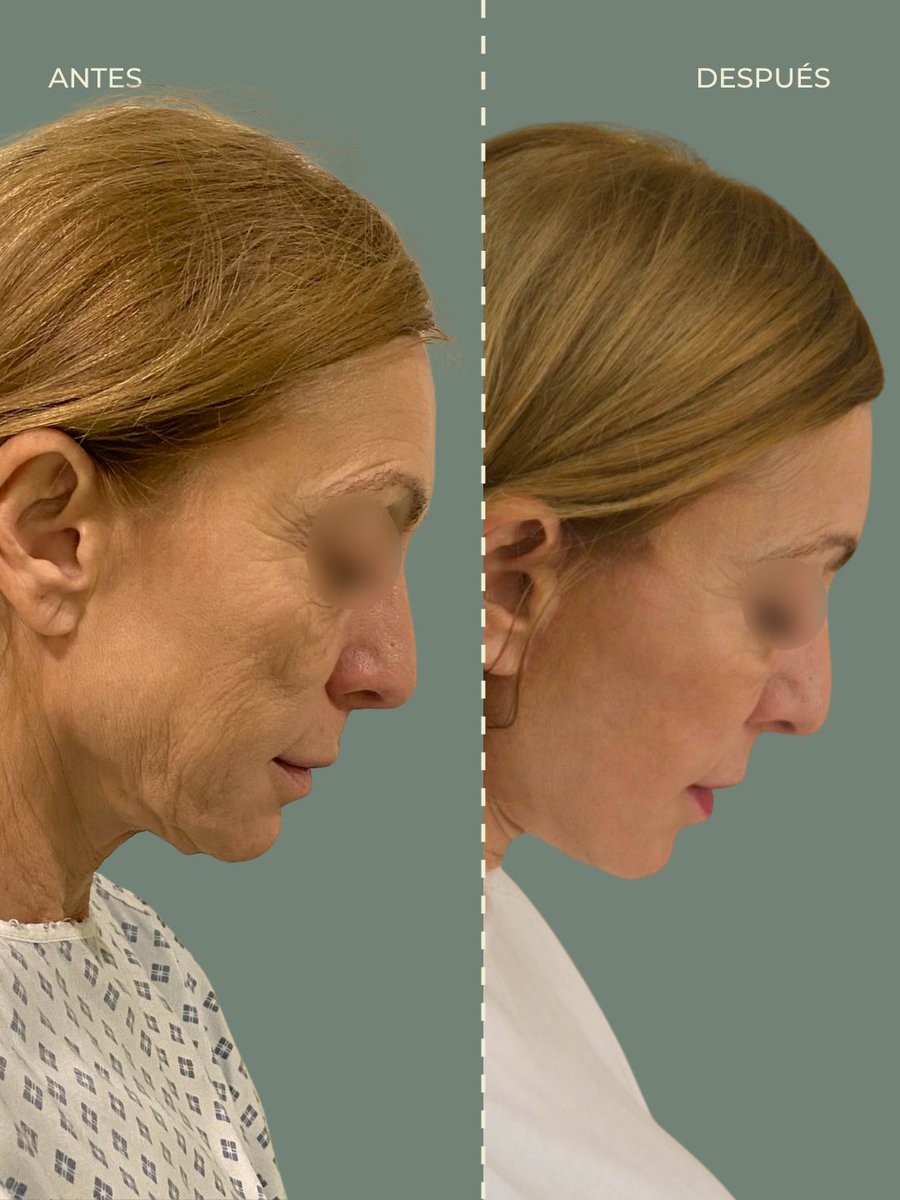ClinicaFEMM's tweet photo. #AntesYDespués de Lifting Facial Deep Plane. 🌟

Con este método rejuvenecemos el rostro en un plano más profundo. Conseguimos una cicatrización mejor y resultados más naturales.

¡Gracias por confiar en nosotros! https://t.co/eX2pqbyQQl