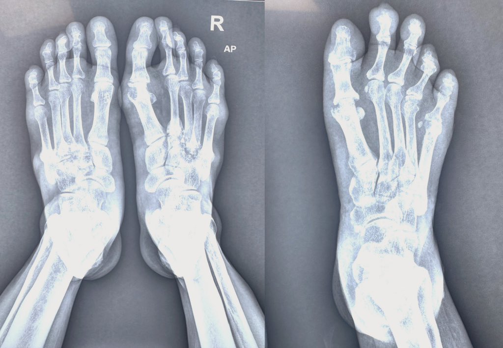 Abhilasha21822's tweet photo. Two erosions.

One due to gout.
The other one is due to RA.

What changed my differential?

👉 Just one bare area.

Small radiographic details = big diagnostic clues. https://t.co/2As39cxCdK