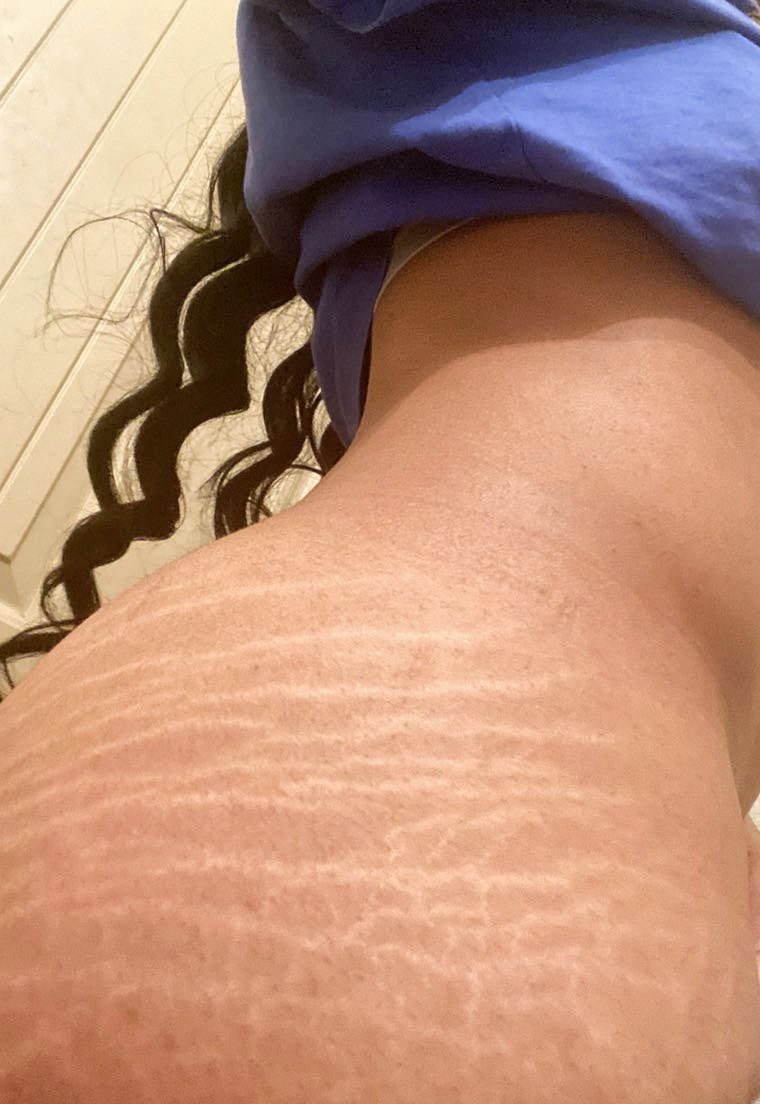 Do men find stretch marks attractive