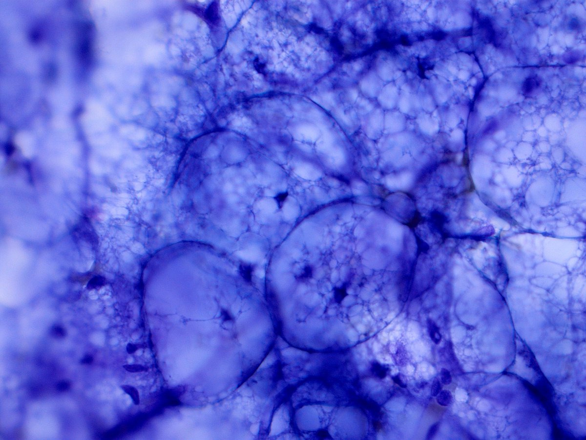 DrCycloPath's tweet photo. 🔬 #CytoQuiz 
Subcutaneous mass on the back
A) Hibernoma
B) Lipoma
C) Granular Cell Tumor
D) Fat Necrosis
#CytoPath #Pathology https://t.co/yOU2KowdD1